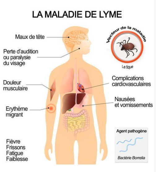 Screenshot_2019-09-08 Maladie de Lyme - Symptômes et traitements - Doctissimo.png